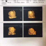 超声 胎儿（四维彩超显示胎儿的鼻子眼睛都是歪的，会不会是畸形）