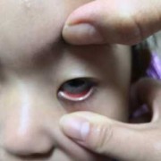胎儿眼睛红（小孩眼睛红还流鼻血是怎么回事）