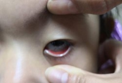 胎儿眼睛红（小孩眼睛红还流鼻血是怎么回事）