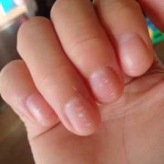 孕期身上有白点（指甲上有白斑是怎么回事）