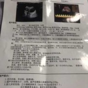 胎儿小脑欠饱满严重吗（胎儿小脑欠饱满严重吗怎么治疗）