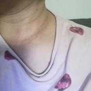 孕期颈纹（孕期颈纹很深产后会消失吗）