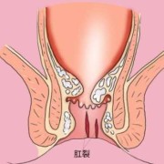 孕期便秘肛裂（孕期便秘肛裂怎么办）