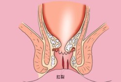 孕期便秘肛裂（孕期便秘肛裂怎么办）
