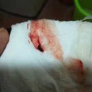 怀孕宫腔积血会流出来吗,孕期宫腔积血是什么原因造成的