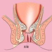 孕期肛裂出血（孕妇肛门出血怎么回事）