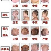 胎儿头扁小（胎儿头扁小）