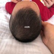 胎儿舟状头（一岁多的宝宝舟状头怎么办）