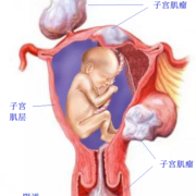 子宫肌瘤会影响胎儿发育吗（怀孕子宫肌瘤会影响胎儿发育吗）