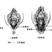 顺产胎儿几斤最合适（顺产下面很大一个洞怎样修复）