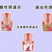孕期阴道干（怀孕以后特别干涩是怎么回事）