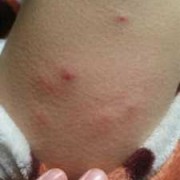 有孕期湿疹（孕妇长湿疹怎么办）