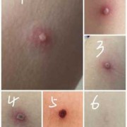 孕妇起水痘怎么办,孕妇得水痘影响胎儿吗知乎