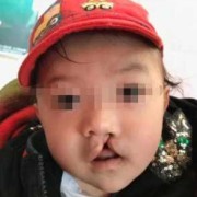 胎儿兔唇怎么办（胎儿兔唇是什么原因造成的）