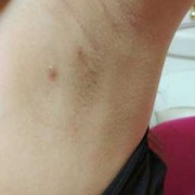 怀孕期间长的副乳图片（怀孕期间长的副乳图片）