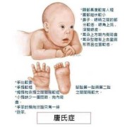 唐氏儿胎儿时的症状,唐氏胎儿有什么表现症状