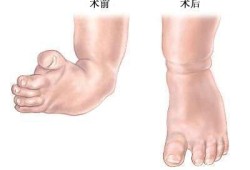 胎儿足畸形（胎儿足畸形种类）