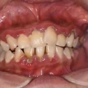 怀孕快9个月了牙出血怎么回事?牙出血是什么原因引起的呢,孕期流牙血怎么回事
