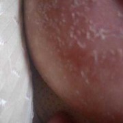 哺乳期乳晕周围脱皮，又有点痒，是怎么回事,孕期乳晕脱皮什么原因