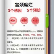 宫颈糜烂孕期（子宫颈糜烂怎么治疗）