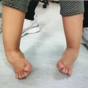 胎儿内翻足（胎儿内翻足在肚子里会好吗）