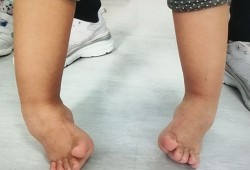 胎儿内翻足（胎儿内翻足在肚子里会好吗）