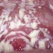孕妇有霉菌性阴炎会影响胎儿吗（怀孕了有霉菌性阴道炎对胎儿有影响吗）