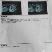 孕18周胎心153一定是女孩吗,胎心音辨别胎儿男女马蹄声