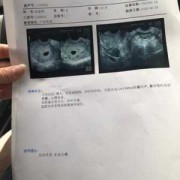 婴儿会阴里很脏怎么清洗,胎儿阴超图片