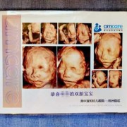 四维查出宝宝心脏畸形怎么办才好的呢,胎儿心脏外翻超声表现