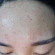 怀孕期间脸上长痘痘该怎么办,怀孕期间粉刺多怎么处理