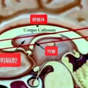 胎儿透明隔腔偏小（胎儿透明隔腔偏小是什么原因造成的）