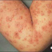 孕妇得水痘生下胎儿（孕妇得水痘生下胎儿）