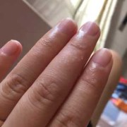 孕期手上长小水泡（孕晚期手上脚上长了许多小水泡咋回事啊）