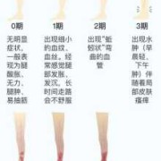 怀孕腿部静脉曲张怎么治疗,孕期静脉曲张如何缓解