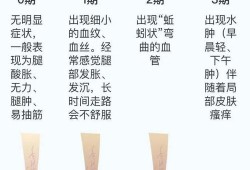 怀孕腿部静脉曲张怎么治疗,孕期静脉曲张如何缓解