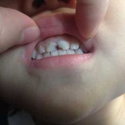 孕妇吃什么胎儿会白（宝宝牙齿有白斑怎么回事？白斑是什么原因引起的呢）