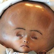 胎儿脑部积水（胎儿脑部积水是怎么引起的）