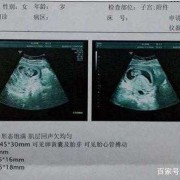 刚出生的婴儿怎么辨别男孩女孩,胎儿男女怎么看b超单