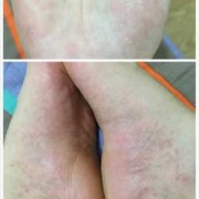 孕晚期手脚痒怎么回事？是不是湿疹啊,孕期手脚湿疹太痒怎么治疗
