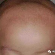胎儿囟门（胎儿囟门位置示意图）