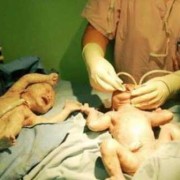 双胞胎孕期图片（38岁的媳妇怀了双胞胎压力大）