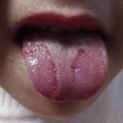 孕妇地图舌影响胎儿吗（孕妇地图舌对胎儿有影响吗）
