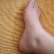 孕妇水肿是怎么回事,孕期水肿表现有哪些