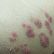 怀孕屁股痒怎么回事,孕期屁眼痒想拉屎又拉不出