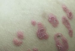怀孕屁股痒怎么回事,孕期屁眼痒想拉屎又拉不出