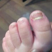 灰指甲对胎儿有影响吗（孕妇得了灰指甲对胎儿有影响吗）