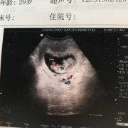 胎儿签定（胎儿签定男孩女孩要多久才有结果单）