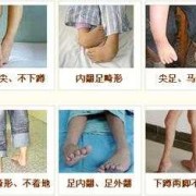 怀孕脑瘫是怎么形成的,胎儿脑瘫的原因有哪些