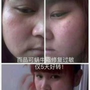 孕妇长湿疹怎么办,孕期脸部湿疹怎么办啊